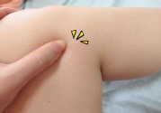 小腿水腫是什么原因引起的？教你輕松解決之道
