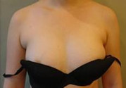 副乳吸脂術怎么做