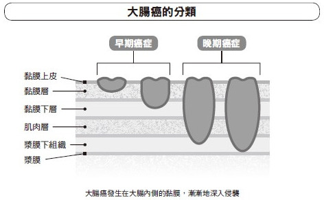 大腸癌的早期癥狀與病程 生活習慣是預防關鍵