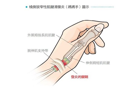 媽媽手腱鞘炎癥狀?1招檢測有無「媽媽手」