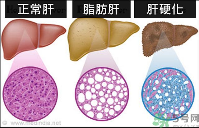 得了脂肪肝該怎么治？脂肪肝對人體危害有多大？