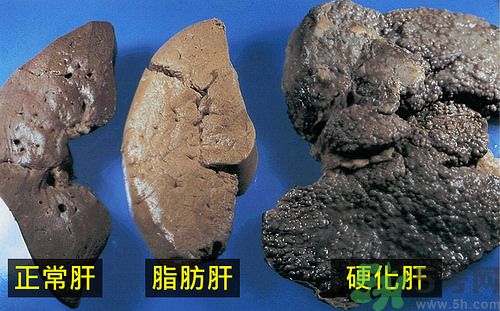 得了脂肪肝該怎么治？脂肪肝對人體危害有多大？