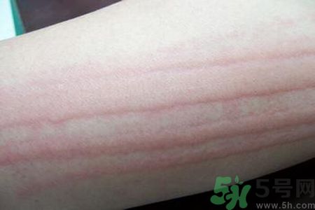 蕁麻疹會不會傳染？蕁麻疹怎么治才能好？
