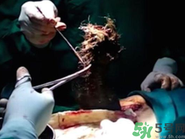 女孩偷吃頭發5年 吃頭發是什么病?.png