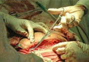 剖腹產傷口多久愈合?剖腹產傷口怎么恢復的快