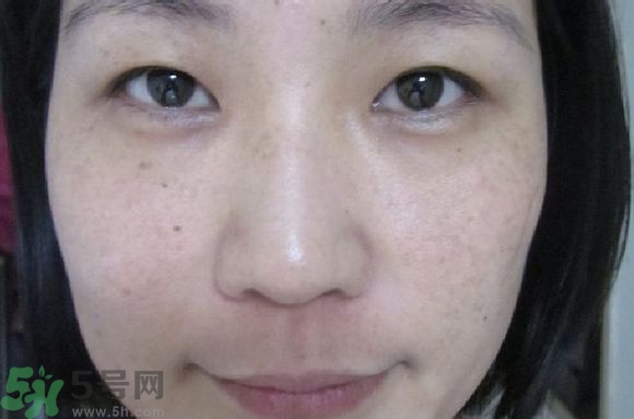 肝斑是肝有問題嗎?肝斑怎么調理簡單方法