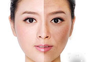 激光美白有用嗎？激光美白可以維持多久？