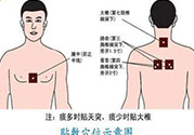 腰痛貼三伏貼有用嗎？腰痛三伏貼貼哪個(gè)穴位？