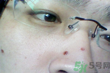 激光點痣后可以洗臉嗎？激光點痣后需要注意什么？