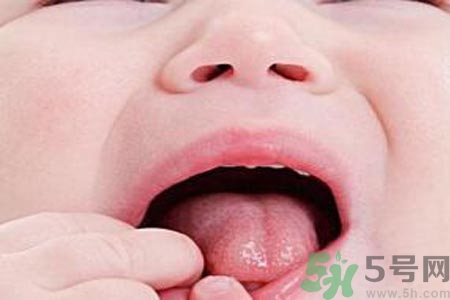 寶寶口腔潰瘍怎么辦？治療寶寶口腔潰瘍方法有什么？