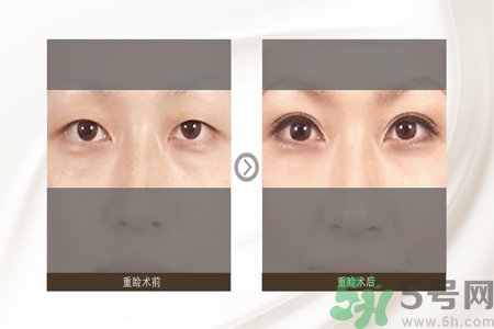 割雙眼皮分哪幾種？割雙眼皮需要多少錢？