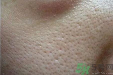 皮膚毛孔粗大原因有哪些？如何預(yù)防皮膚毛孔粗大？