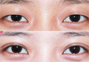 割雙眼皮分哪幾種？割雙眼皮需要多少錢？