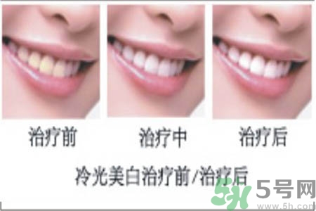 冷光美白牙齒是什么？冷光美白牙齒的好處有哪些？