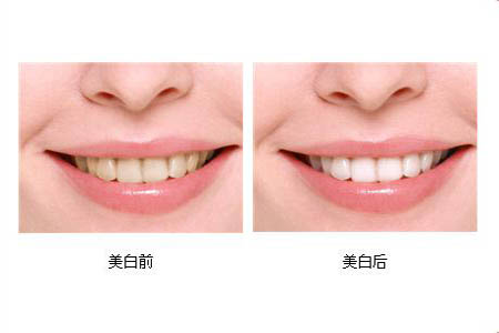 冷光美白牙齒可以保持多長時間？冷光美白牙齒有副作用嗎？