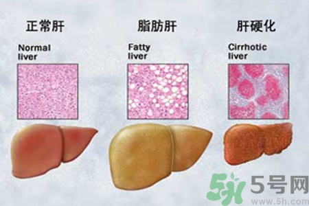 妊娠急性脂肪肝是什么？妊娠急性脂肪肝的治療方法？