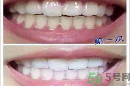 冷光美白牙齒的價格是多少？做冷光美白牙齒需要多少錢？