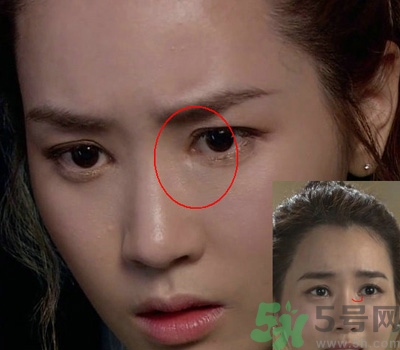 開眼角多少錢？開眼角有什么危害？