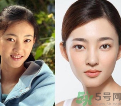 開眼角眼睛會變大嗎？開眼角眼睛能大多少？