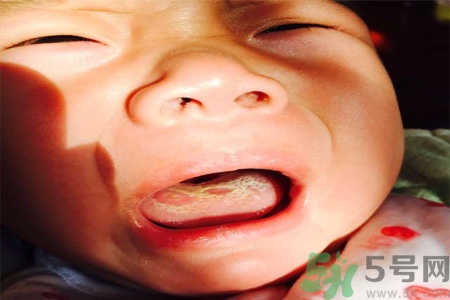 舌頭燙傷后該怎么辦呢？舌頭燙傷后應(yīng)該注意吃什么？?