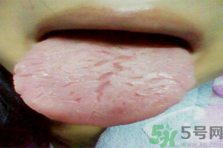 舌頭上有裂紋是怎么辦？舌頭上有裂紋是什么原因？