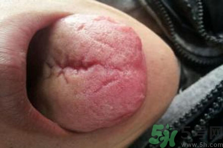 舌頭上有裂紋是怎么辦？舌頭上有裂紋是什么原因？