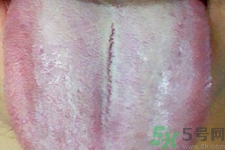 舌頭發白是什么原因？舌苔發白是怎么辦？