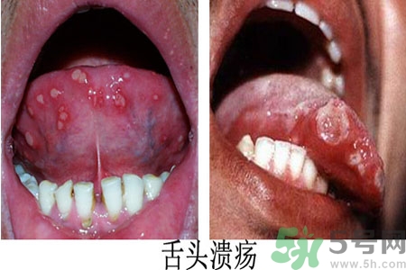 舌頭潰瘍怎么辦？舌頭潰瘍的原因？