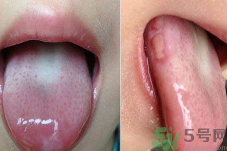 舌頭潰瘍怎么辦？舌頭潰瘍的原因？