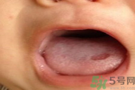舌頭潰瘍怎么辦？舌頭潰瘍的原因？