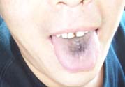 舌頭發(fā)黑怎么回事？舌頭發(fā)黑怎么辦？
