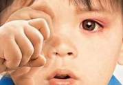寶寶得了紅眼病怎么辦？寶寶得了紅眼病怎么治？