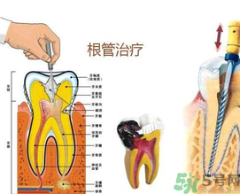 什么是根管治療？為什么牙齒疼要做根管治療？