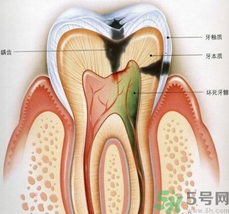 什么是根管治療？為什么牙齒疼要做根管治療？