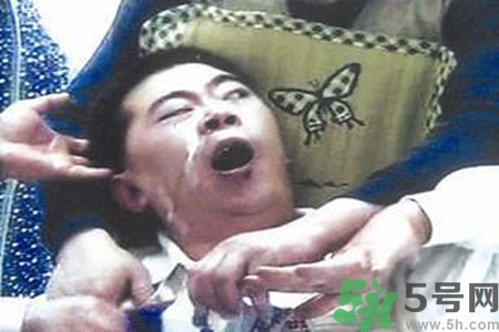 癲癇的典型癥狀有哪些？癲癇是什么？