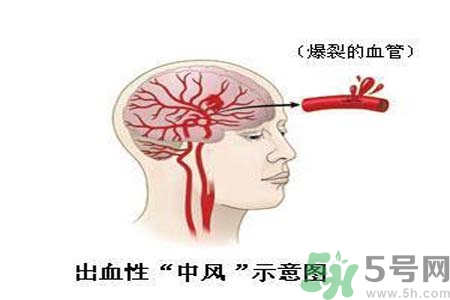 腦中風的護理措施？腦中風的飲食護理？