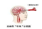 腦中風(fēng)的發(fā)病因素？腦中風(fēng)的并發(fā)癥有哪些 ？