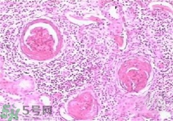慢性腎炎能治好嗎？慢性腎炎能活多久？