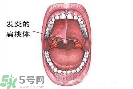 慢性咽炎是什么？慢性咽炎的癥狀有哪些？