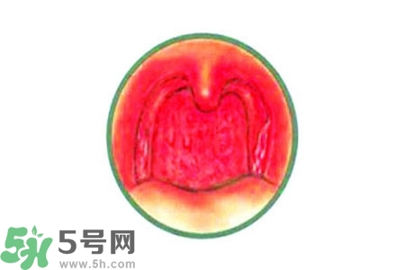 慢性咽炎的治療方法?慢性咽炎的藥物治療? 慢性咽炎的治療方法?慢性咽炎的藥物治療?