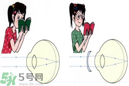 近視眼的發病因素？近視眼的并發癥有哪些？