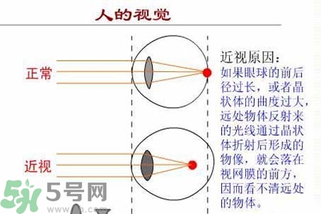近視眼高發(fā)人群？如何預(yù)防近視眼？