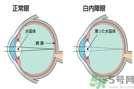 白內障的發病因素是什么？白內障并發癥有哪些？