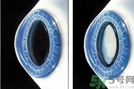 白內障的發病因素是什么？白內障并發癥有哪些？