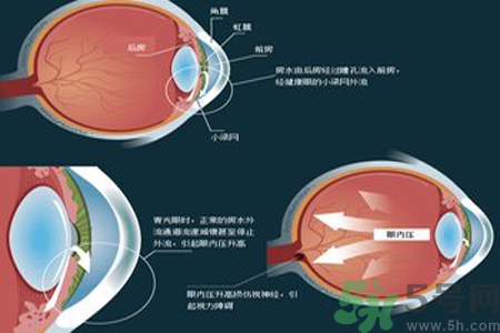 青光眼的高發人群有哪些？如何預防青光眼？