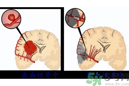 腦出血的發病因素是什么？腦出血的并發癥有哪些？