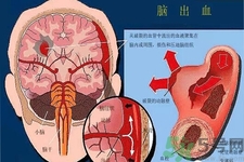 腦出血的發病因素是什么？腦出血的并發癥有哪些？