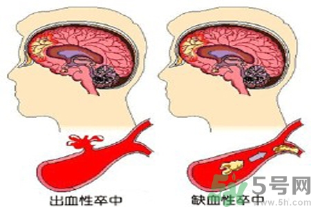 腦出血的治療方法是什么？腦出血可以用哪些藥物治療？