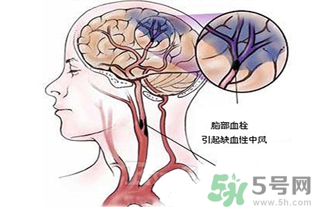 腦出血的治療方法是什么？腦出血可以用哪些藥物治療？