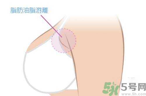 副乳是什么？副乳的危害